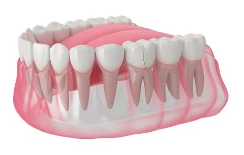 3d render of jaw with cracked tooth Illustrazione stock