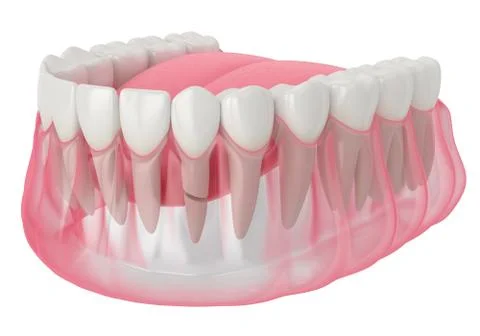 3d render of jaw with cracked tooth root Illustrazione stock