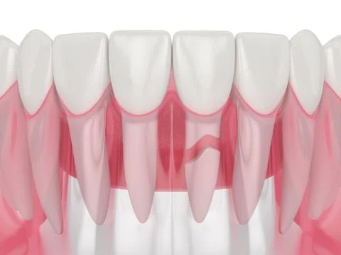 3d render of jaw with cracked tooth root Stock Photos