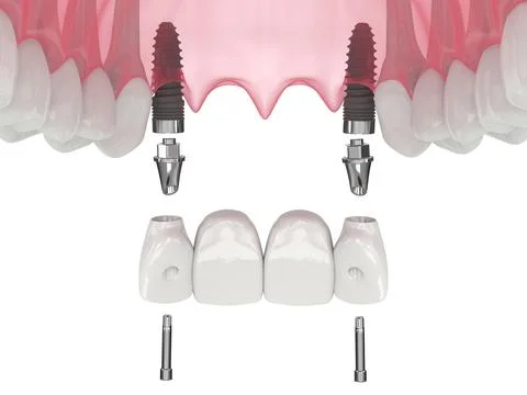 3d render of jaw with de3d render of jaw with dental incisors bridge supporte Stock Illustration