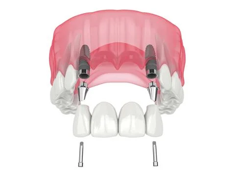 3d render of jaw with de3d render of jaw with dental incisors bridge supporte Stock Illustration