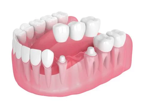 3d render of jaw with dental bridge Stock Illustration