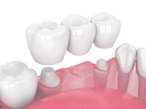 3d render of jaw with dental bridge Stock Illustration