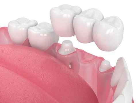 3d render of jaw with dental bridge Stock Illustration