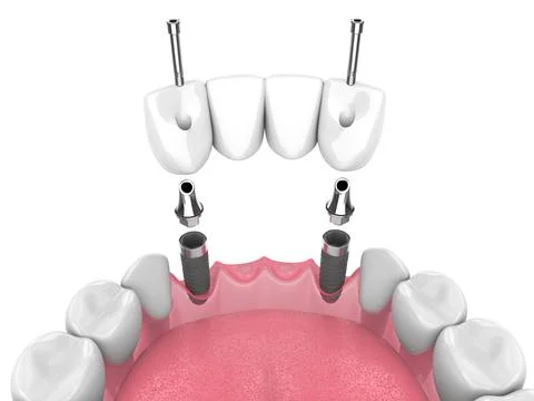 3d render of jaw with dental bridge supported by implants over white 스톡 사진