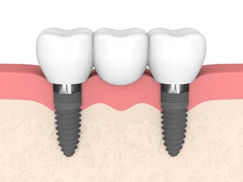3d render of jaw with dental bridge supported by implants over white 스톡 사진