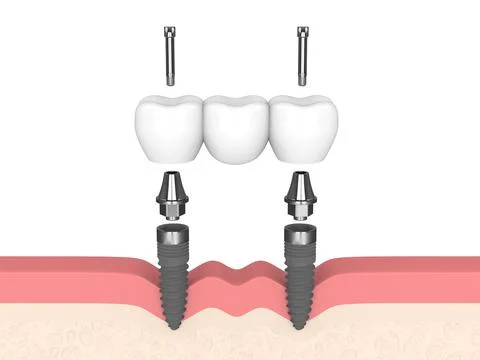 3d render of jaw with dental bridge supported by implants over white 스톡 사진