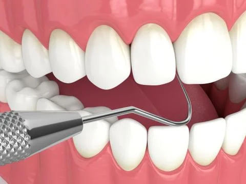 3d render of jaw with dental explorer Stock Illustration