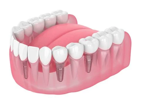 3d render of jaw with dental implants Stock Illustration