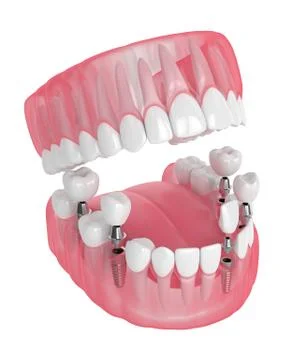 3d render of jaw with dental implants Stock Illustration