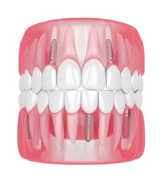 3d render of jaw with dental implants Stock Illustration