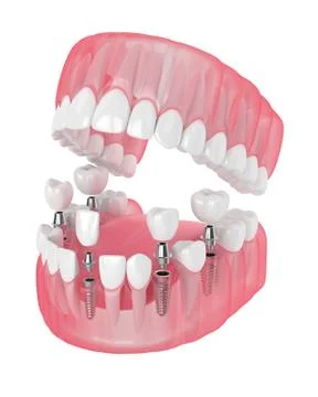 3d render of jaw with dental implants Stock Illustration