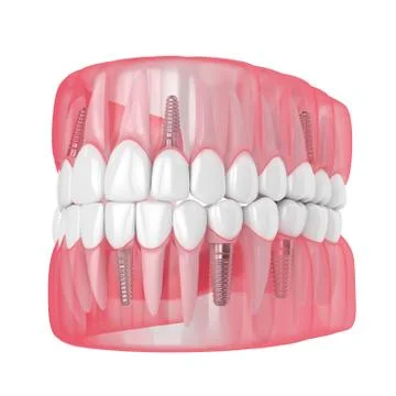 3d render of jaw with dental implants Stock Illustration
