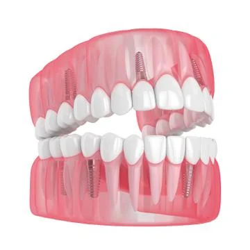 3d render of jaw with dental implants Stock Illustration
