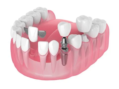 3d render of jaw with dental implants and bridges over white Stock Illustration