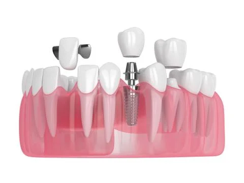 3d render of jaw with dental implants and bridges over white Stock Illustration