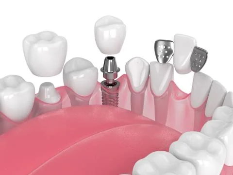 3d render of jaw with dental implants and bridges over white Illustrazione stock