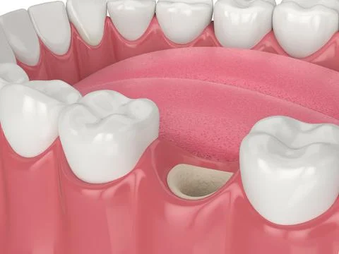 3D render of jaw with empty socket ready to bone grafting. Stock Illustration