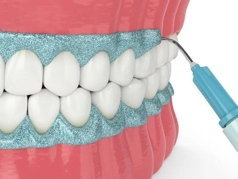3d render of jaw with gingival mask before teeth bleaching Stock Illustration