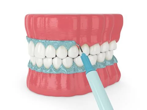 3d render of jaw with gingival mask before teeth bleaching Illustrazione stock