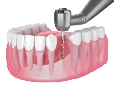 3d render of jaw with gum drilling Stock Illustration
