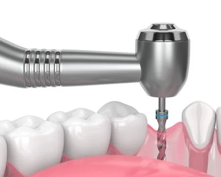 3d render of jaw with gum drilling Stock Illustration