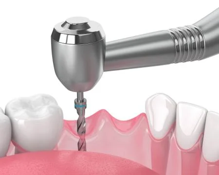 3d render of jaw with gum drilling Stock Illustration