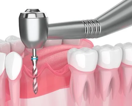 3d render of jaw with gum drilling Stock Illustration