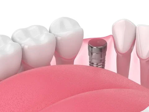 3d render of jaw with implant screw and buried healing cap Stock Illustration