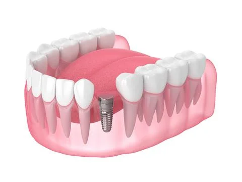 3d render of jaw with implant screw and buried healing cap under gums Stock Illustration