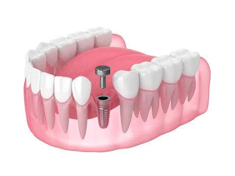 3d render of jaw with implant screw and healing cap Stock Illustration