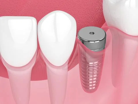 3d render of jaw with implant screw and healing cap Ilustração Stock