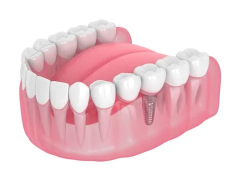 3d render of jaw with implant supported dental cantilever bridge Stock Illustration