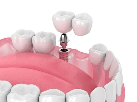 3d render of jaw with implant supported dental cantilever bridge Stock Illustration