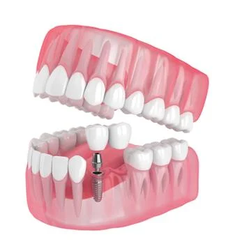 3d render of jaw with implant supported dental cantilever bridge Illustrazione stock