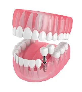 3d render of jaw with implant supported dental cantilever bridge Stock Illustration