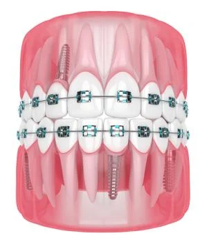 3d render of jaw with implants and orthodontic braces Stock Illustration