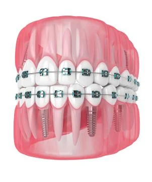 3d render of jaw with implants and orthodontic braces Stock Illustration