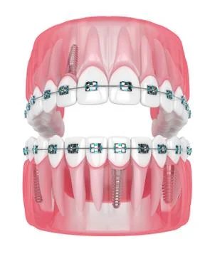 3d render of jaw with implants and orthodontic braces Illustrazione stock