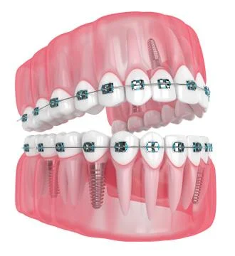 3d render of jaw with implants and orthodontic braces Illustrazione stock