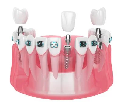 3d render of jaw with implants and orthodontic braces Stock Illustration