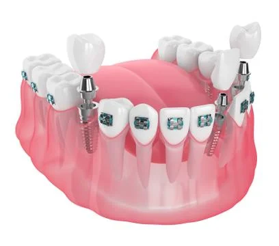 3d render of jaw with implants and orthodontic braces Stock Illustration