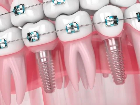 3d render of jaw with implants and orthodontic braces Stock Illustration