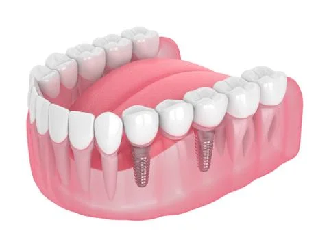 3d render of jaw with implants supported dental bridge Stock Illustration