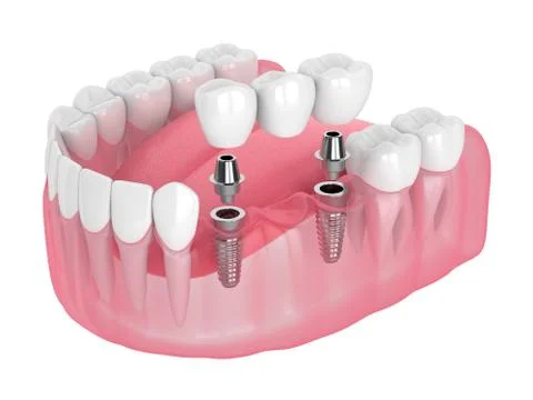 3d render of jaw with implants supported dental bridge Stock Illustration