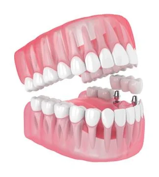3d render of jaw with implants supported dental bridge Stock Illustration