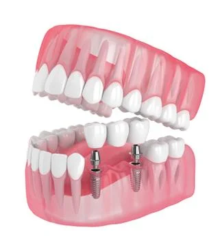 3d render of jaw with implants supported dental bridge Stock Illustration