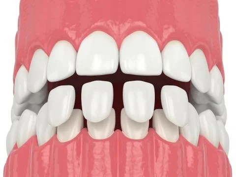 3d render of jaw with lower veneers Illustrazione stock
