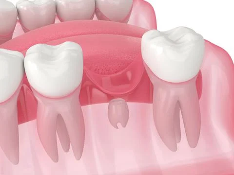 3d render of jaw with new tooth growing between two teeth Stock Illustration