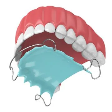 3d render of jaw with orthodontic removable retainer Stock Illustration